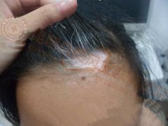 9岁女童额头发际中央部位白斑两个月治愈